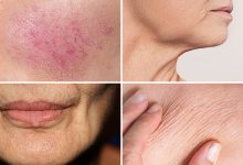 Skin Issues for each Type